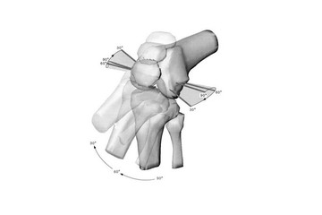 Innoverende techniek bij plaatsen van knieprothese