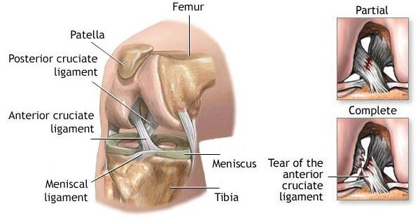 Rupture du ligament croisé et chirurgie - Orthopédie Roulers