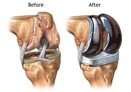 Prothèse du genou pour l'arthrose - Orthopédie Roulers