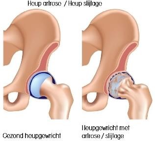 L’arthrose ou l’usure de l’articulation de la hanche est la conséquence d’une perte de cartilage