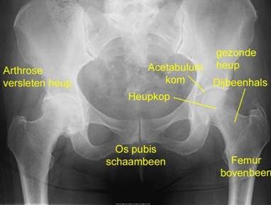 Osteoarthritis or wear and tear of the hip joint is the result of a loss of cartilage in the hip socket and the femoral head.
