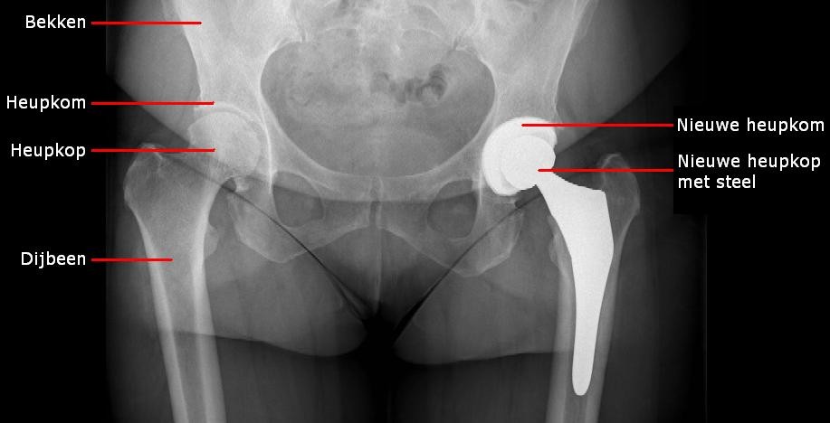 Wear and tear of the joint’s smooth layer of cartilage is the main reason for deciding to have a hip replacement.