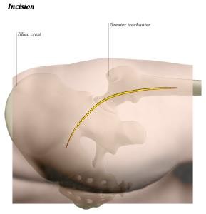 A hip prosthesis is inserted via an incision in the upper leg.