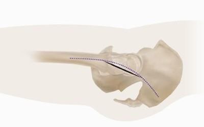 Een heupprothese wordt geplaatst via een insnede op het bovenbeen.